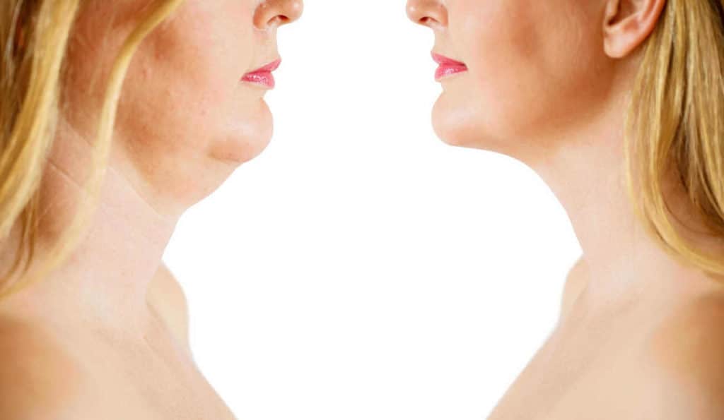 Double Chin treatment Chapel House before and after results