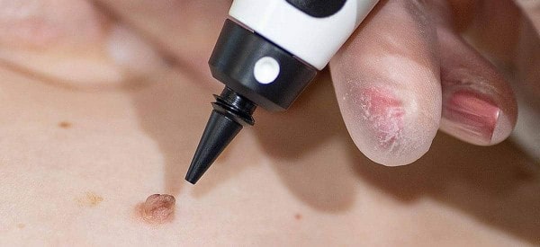 After Skin Tag Removal Chapel House