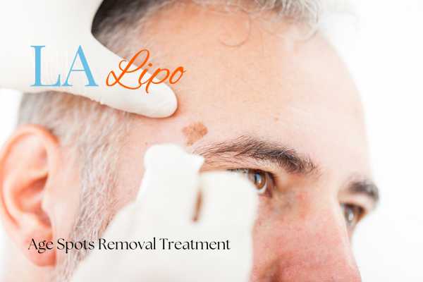 What Are the Most Effective Treatments for Age Spots Chapel House?