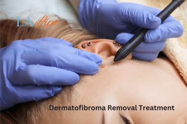 Dermatofibroma Removal Treatment Chapel House