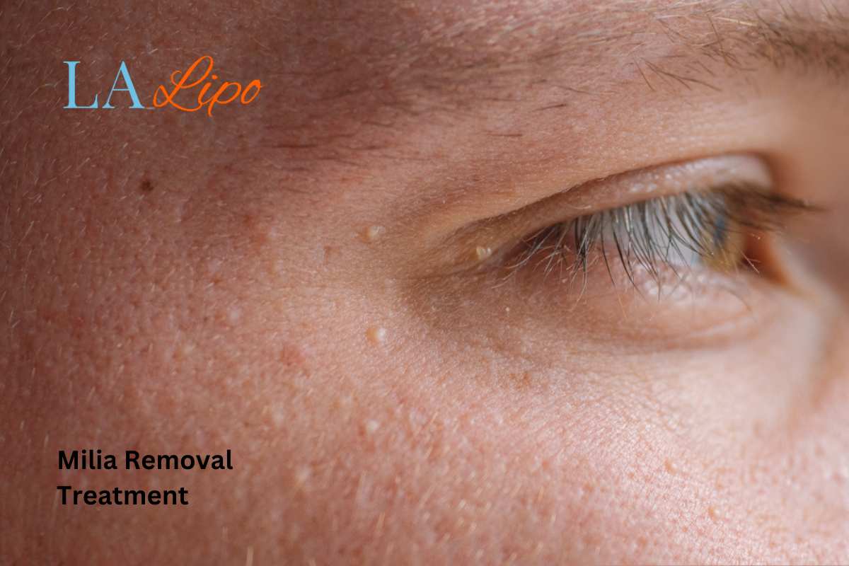 Cryopen Milia Removal: Is It the Easiest and Safest Option Chapel House?
