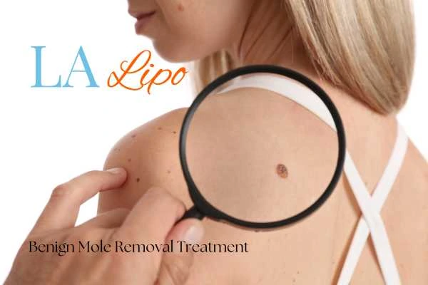 Woman having her inspection of blemish before mole removal Chapel House