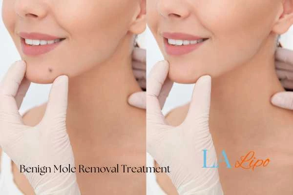 woman's before and after mole removal Chapel House results