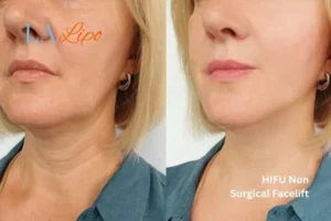 hi-fu for wrinkles Chapel House before and after results