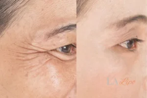 Before and after results of woman - HI-fu wrinkles reduction treatment Chapel House