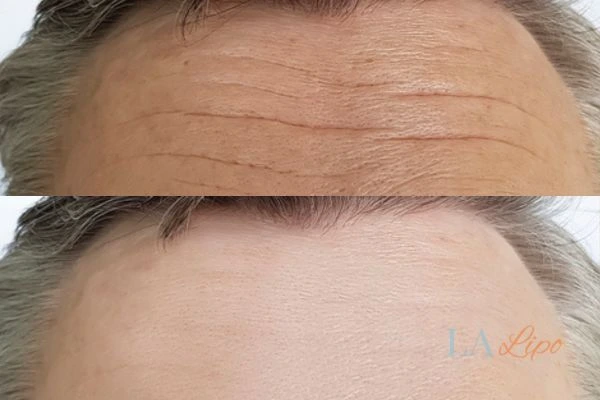 results of HIFU Chapel House on mans forehead to help reduce lines and wrinkles