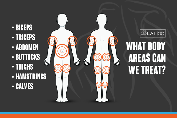 Graphic to show areas you can have LA-EMS Body Sculpting Chapel House treatment.
