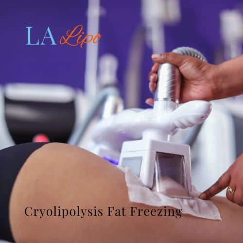fat freezing - Cryolipolysis Chapel House
