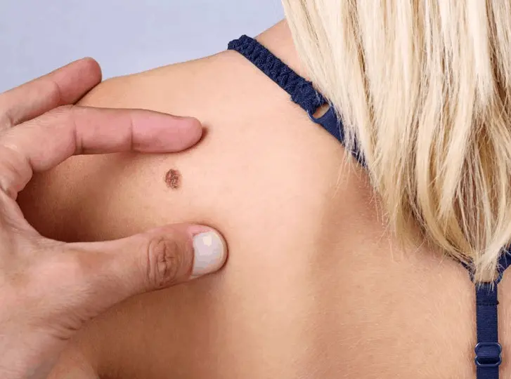woman having mole removal Chapel House consultation before treatment.