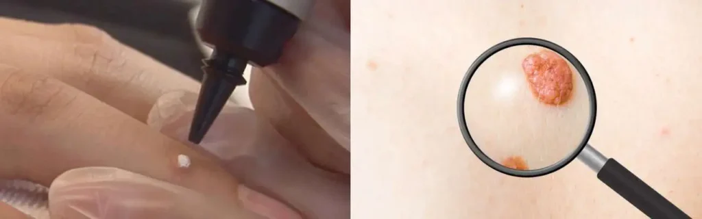 Cryopen for mole removal Chapel House - speak to our team today!