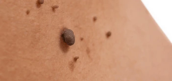 image of a skin tag Chapel House