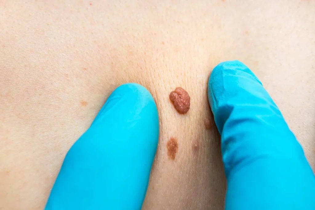 Consultant examining a skin tag Chapel House