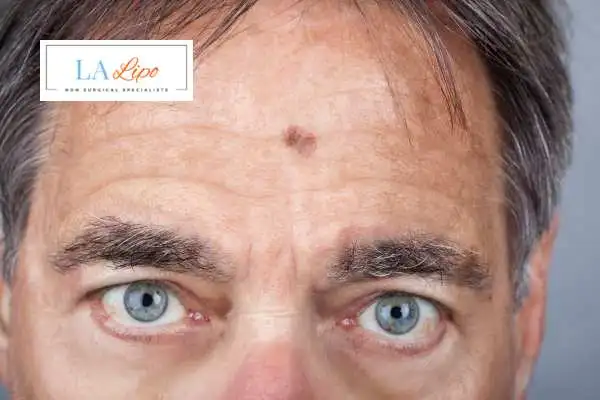 Solar Lentigo Removal Chapel House image of man with mark on his forehead