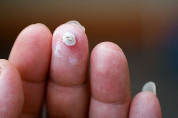 wart on person finger - cryotherapy to treat from LA LIPO Chapel House