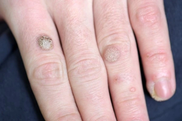 photo of warts on person hand - see wart removal Chapel House from LA LIPO