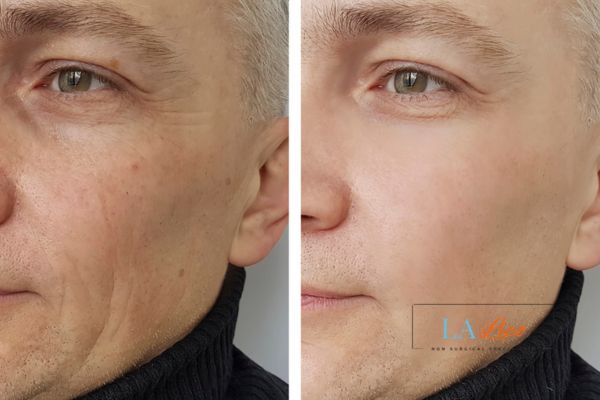 See the amazing results of Morpheus8 Treatment Chapel House!
