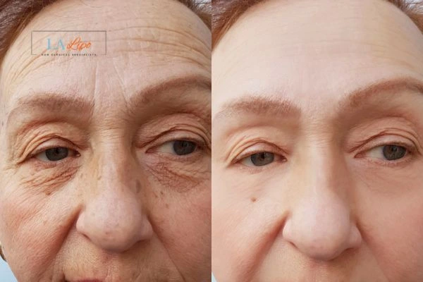 The powerful benefits of Morpheus8 Treatment Chapel House - Call Our team today!
