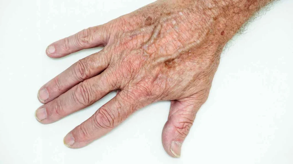 Male hand showing age spot Chapel House