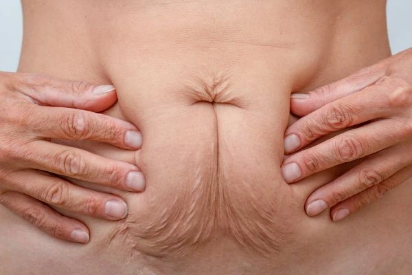 Image of a woman's stomach with loose skin - example of skin tightening Chapel House options