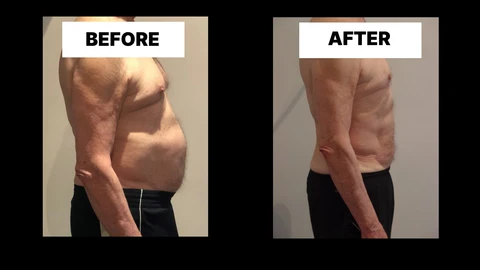 What Symptoms Can Diastasis Recti Cause in Men? Weak Core, Back Pain and Poor Posture Chapel House